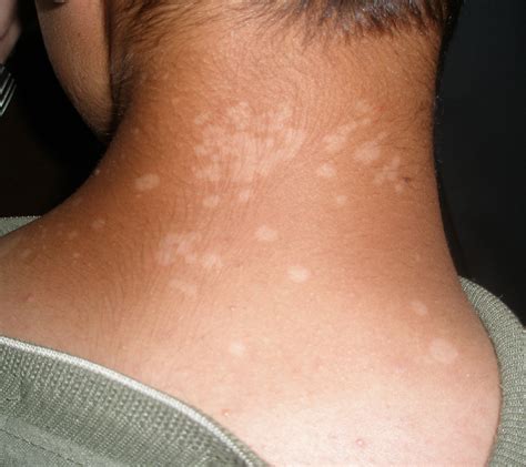 Tinea Versicolor  A Cause of Circular Patches on the Trunk ...