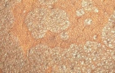 Tinea versicolor | American Academy of Dermatology
