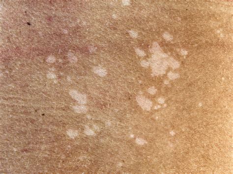 Tinea Versicolor: Stubborn Skin Condition?   Dr.Weil