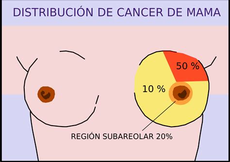 Tipos anatomopatológicos de cáncer de mama   Wikipedia, la ...
