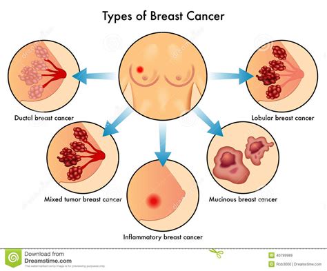 Tipos de câncer da mama imagem de stock. Imagem de ...