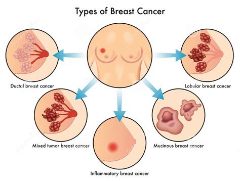 Tipos de cáncer de mama   Mujer de 10