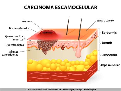 Tipos de cáncer de piel   Cáncer de Piel