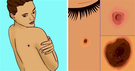 Tipos de cáncer de piel y cómo detectarlos