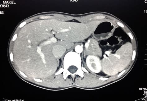 Tomografía computada de abdomen, con contraste | 2014 ...