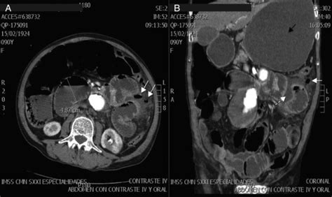 Tomografía de abdomen con contraste intravenoso. A  Corte ...