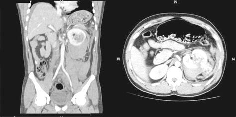 Tomografía de abdomen y pelvis