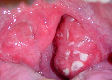 Tonsil Pain Side