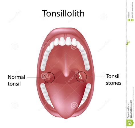 Tonsil Stones | Health Hub London   Private Medical Centre