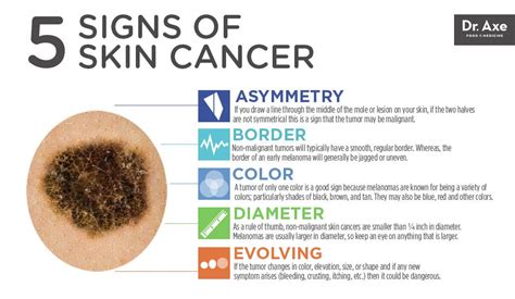 Top 5 Skin Cancer Symptoms & 4 Natural Treatments