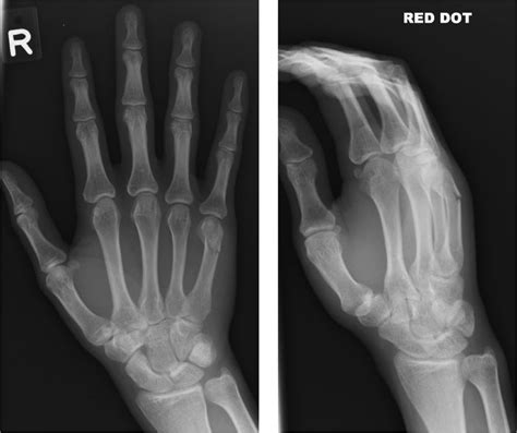 Top 5th Metacarpal Fracture Hand Images for Pinterest Tattoos