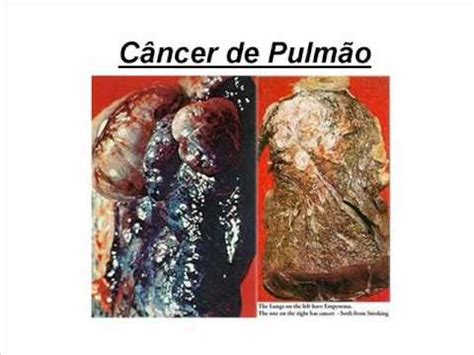 Trabalho sobre o Câncer de Pulmão   YouTube