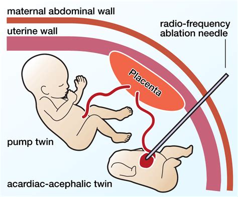 TRAP Sequence or Acardiac Twin | UCSF Fetal Treatment Center