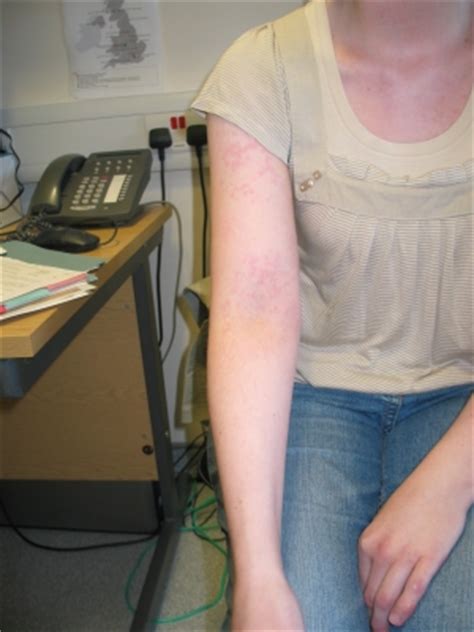 traps syndrome   pictures, photos