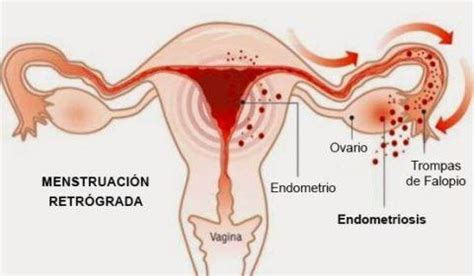 Trastornos en la menstruación: causas, tipos y ...