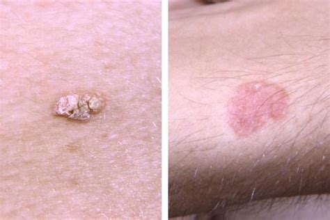 Tratamento para câncer de pele