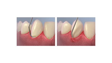 Tratamiento de enfermedad periodontal   Urbandental Barakaldo