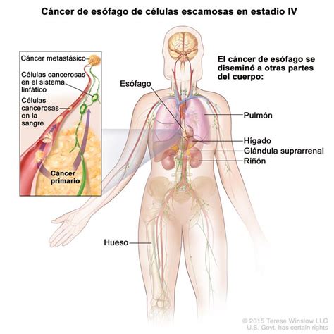 Tratamiento del cáncer de esófago  PDQ® —Versión para ...