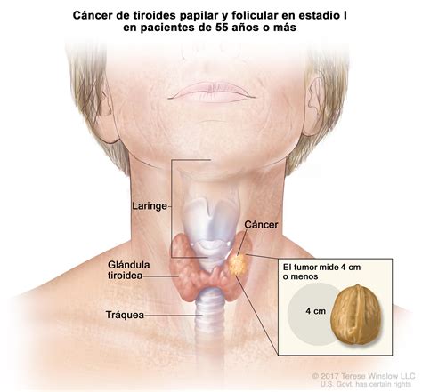 Tratamiento del cáncer de tiroides  PDQ® —Versión para ...