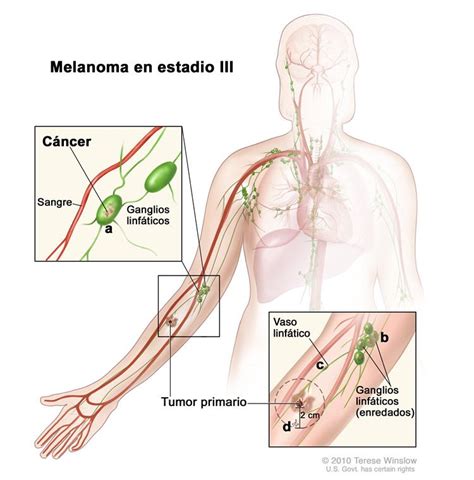 Tratamiento del melanoma  PDQ® —Versión para pacientes ...