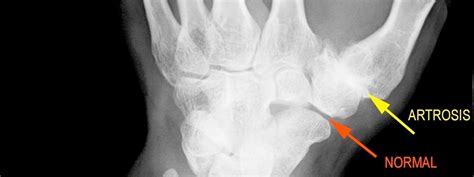 Tratamiento y solución quirúrgica a la artrosis en las ...