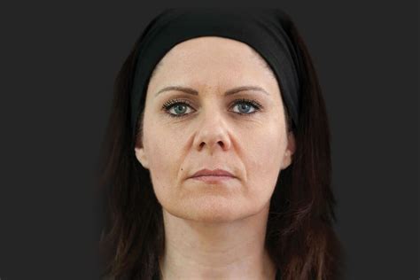 Tratamientos contra la flacidez facial   Estética Facial