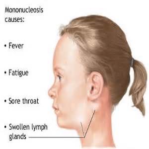 Treat yourself from Mononucleosis   Simple and easy remedies
