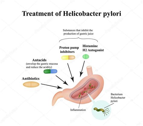 Treatment of Helicobacter pylori. Medications. Antacids ...