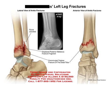 Triplane Ankle Fracture Related Keywords   Triplane Ankle ...