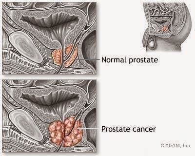 TU SALUD: Cómo curar la próstata  cáncer de próstata, HPB ...