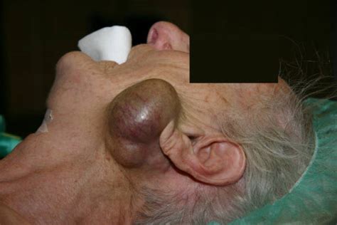 Tumeur de la glande parotide   DocCheck Pictures