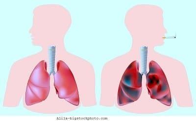 Tumor al pulmón, benigno, maligno, cáncer, liquido pleural ...