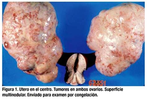Tumor de krukenberg