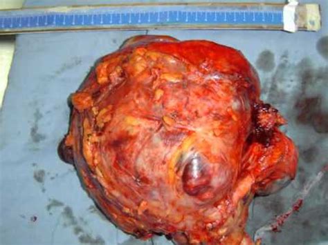 Tumor de ovario. Tratamiento quirúrgico.   YouTube
