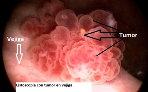 Tumor de vejiga tratamiento y consulta   DrenLinea