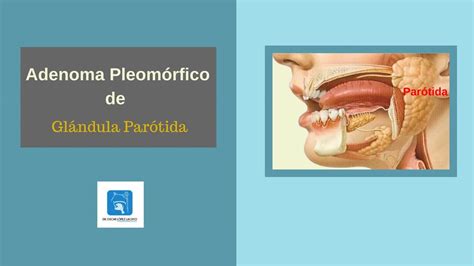 Tumor en la glándula parótida   Adenoma pleomórfico ¿es ...