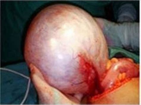 Tumor Gigante De Ovario