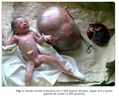 Tumor gigante de ovario y embarazo. A propósito de un caso
