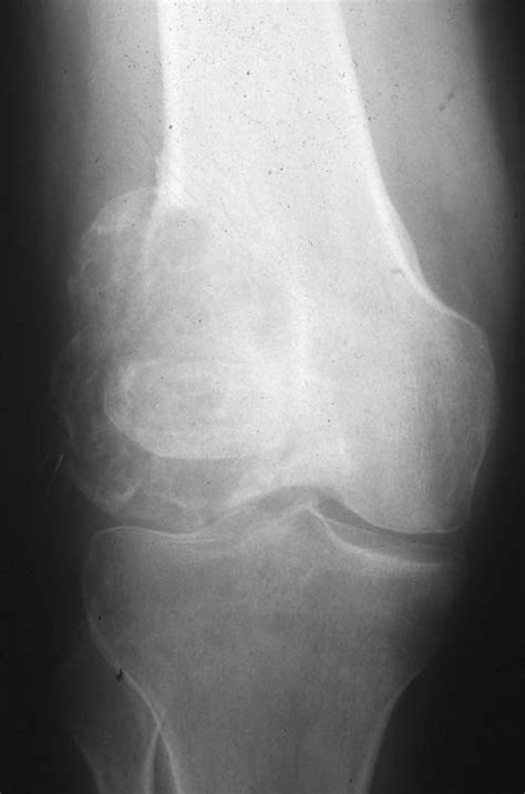 Tumor: Knee Tumor