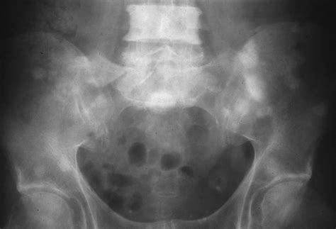 Tumor Library   Metastatic prostate carcinoma   Pelvis   X ray