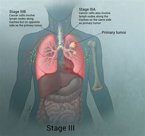 Tumor Lung Cancer | www.pixshark.com   Images Galleries ...