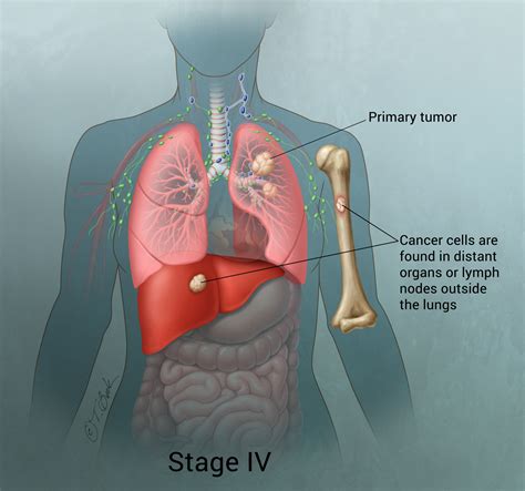 Tumor Lung Cancer | www.pixshark.com   Images Galleries ...