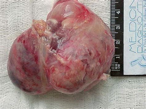 Tumor: Mediastinal Tumor