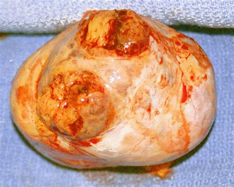 Tumor: Ovarian Tumors