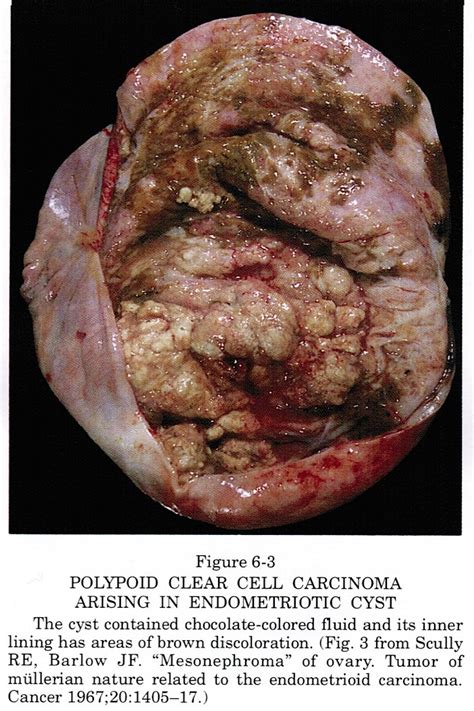 Tumor: Ovarian Tumors