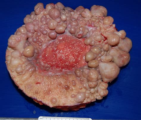 Tumor: Peripheral Nerve Sheath Tumor