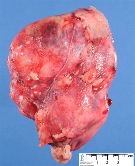 Tumor: Renal Tumor
