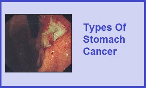 Tumor: Stomach Tumor Symptoms