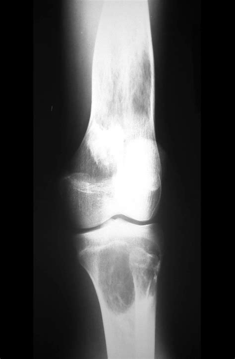 Tumor Symptoms: Bone Tumor In Knee Symptoms