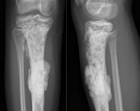 Tumor Symptoms: Bone Tumor In Knee Symptoms